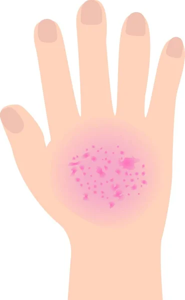 Eczeem Beïnvloed Een Hand Dermatologie Huidziekte Concept Vector Illustratie Een — Stockvector