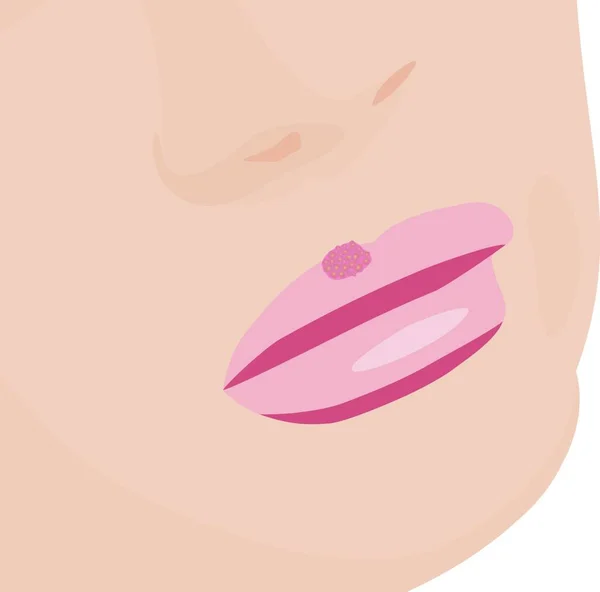 唇のくびれによる水疱イラスト ウイルス感染スキンケア問題 — ストックベクタ
