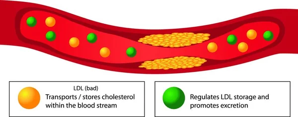 Aterosklerotisk Plack Blodkärl Och Bra Och Dåliga Lipider Vektor Infographics — Stock vektor