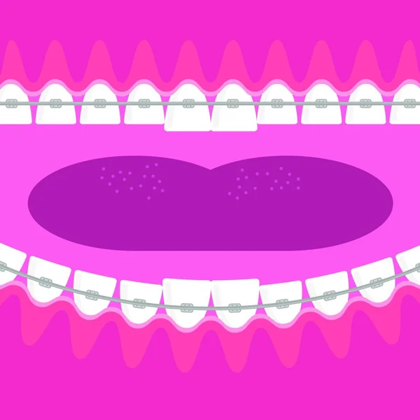 Medyczne Szelki Zęby Pielęgnacja Zębów Tło Leczenie Ortodontyczne Kreskówka Otwór — Wektor stockowy