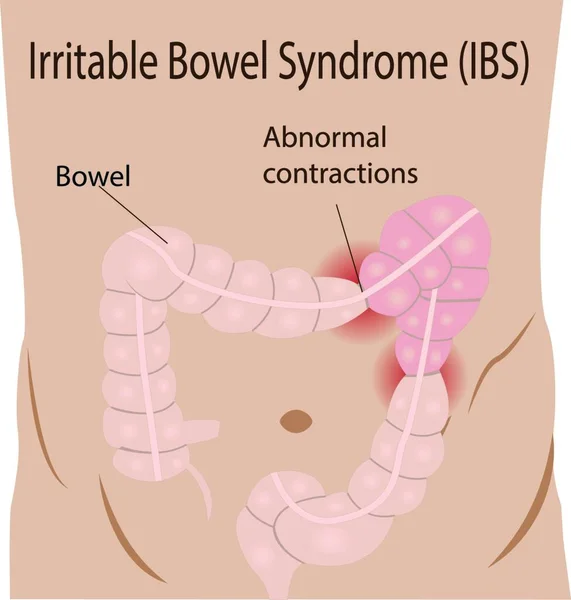 大腸のベクトル図に過敏性腸症候群 Ibs — ストックベクタ