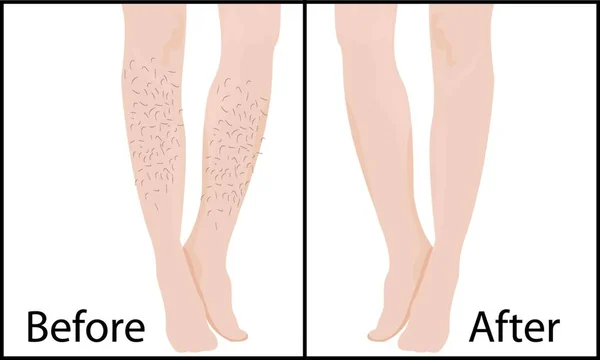 Antes Depois Remoção Cabelo Métodos Resultados Ilustração Vetorial — Vetor de Stock