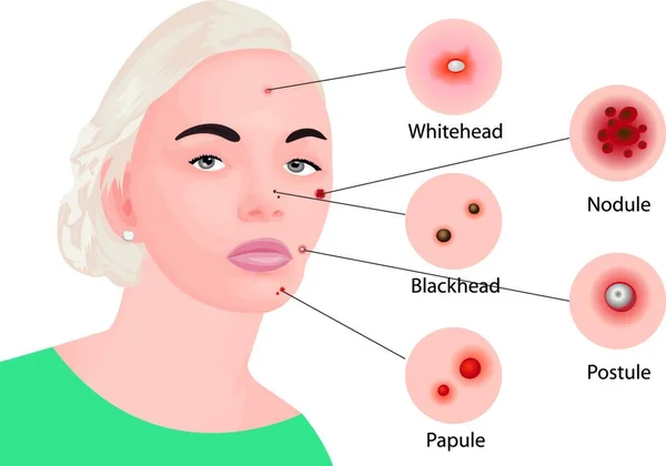 Acne Typer Kvinna Ansikte Vektor Illustration Kosmetika Koncept Dermatologi Hudsjukdom — Stock vektor