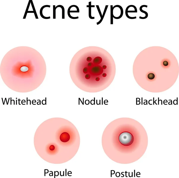 Acne Soorten Problemen Huid Dermatologie Vector Illustratie — Stockvector