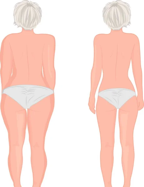 Gemuk Dan Gadis Langsing Kembali Lemak Paha Liposuction Sebelum Dan - Stok Vektor
