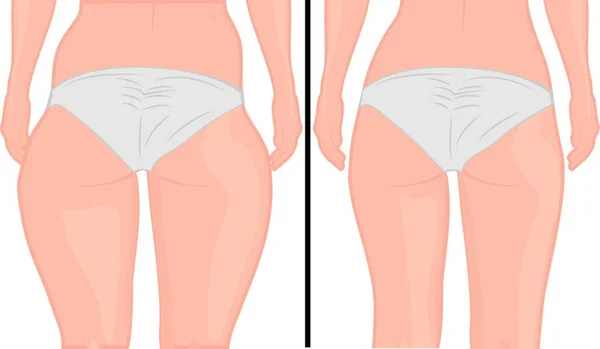 Şişko Kızın Geri Ince Şişman Thig Liposuction Önce Sonra Kadın — Stok Vektör