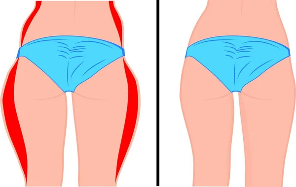 Rapariga Gorda Magra Voltou Ladrão Gordo Lipoaspiração Antes Depois Mulher —  Vetores de Stock