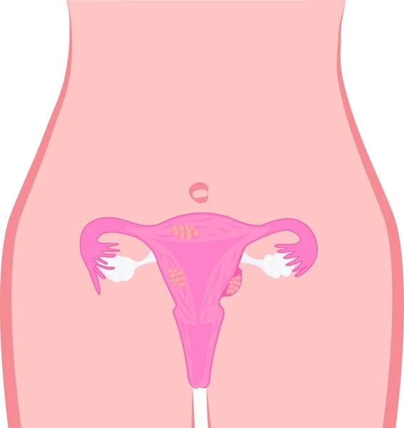 Uterine Fibroid Vector Illustration Problema Ginecología Tumor Órgano Reproductor Femenino — Vector de stock