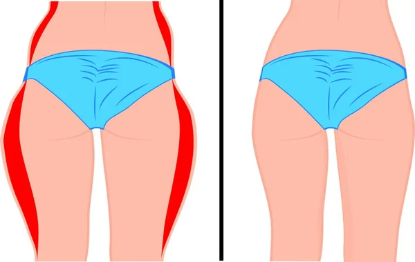 Fat Slim Girl Back Fat Thig Liposuction Woman Body Correction — Stock Vector