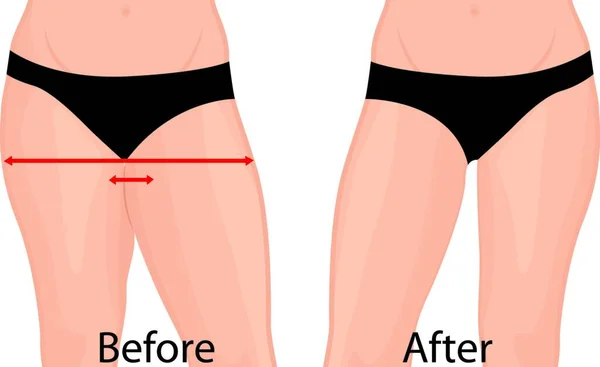 Fat Slim Girl Back Fat Thig Liposuction Woman Body Correction — Stock Vector