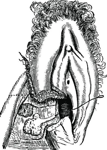 人类的秃鹫腺 古老的雕刻插图 Labarthe博士的 普通医学词典 1885年 — 图库矢量图片