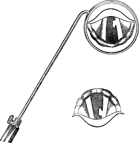 喉部的一部分 如通过喉镜看到的 古老的雕刻插图 Labarthe博士的 普通医学词典 1885年 — 图库矢量图片