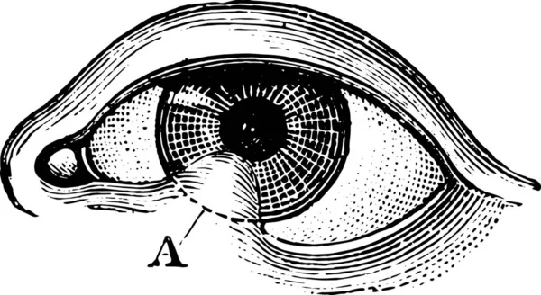 Symblepharon ของเปล อกตาล างภาพแกะสล นเทจ พจนาน กรมการแพทย ปกต โดย Labarthe — ภาพเวกเตอร์สต็อก