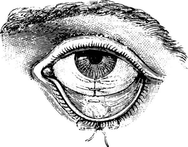 Symblepharon的行动 缝合线的结膜 老式雕刻插图 Labarthe博士的 普通医学词典 1885年 — 图库矢量图片