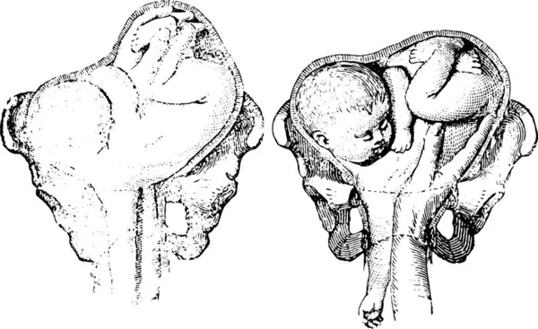 1255年 版本在左肩的第二位置 介绍手和脚的入口 1256年版本在右肩的第二个位置 进入脚 老式雕刻插图 Labarthe博士的 普通医学词典 1885年 — 图库矢量图片
