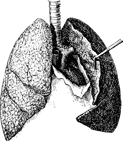 古い人間の肺の白い背景で隔離の図は刻まれています 言葉と事物 Larive フルーリの辞書ですか 1895 — ストックベクタ