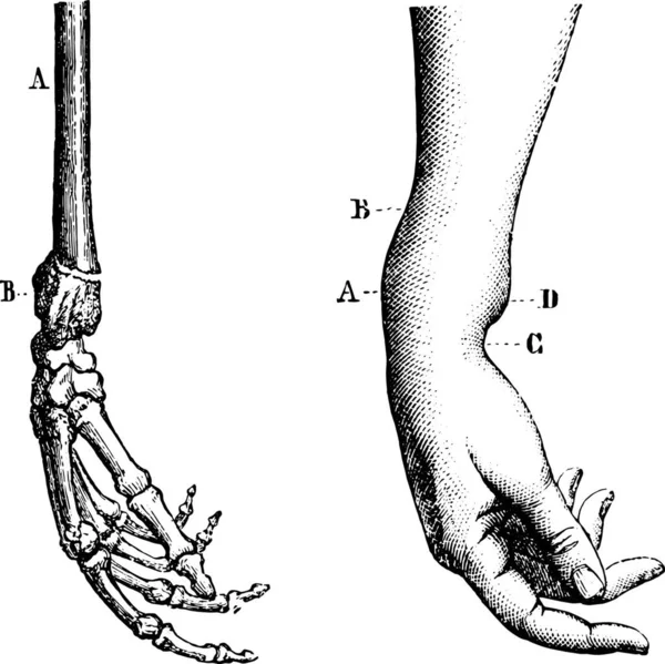 Fratura Extremidade Inferior Raio Ilustração Gravada Vintage Dicionário Medicina Usual — Vetor de Stock