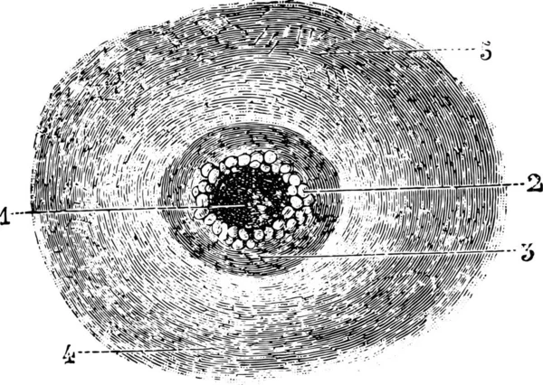 悪性のパスタルや炭疽菌 ヴィンテージ刻まれたイラスト ラブラドール博士の医学辞典 1885 — ストックベクタ