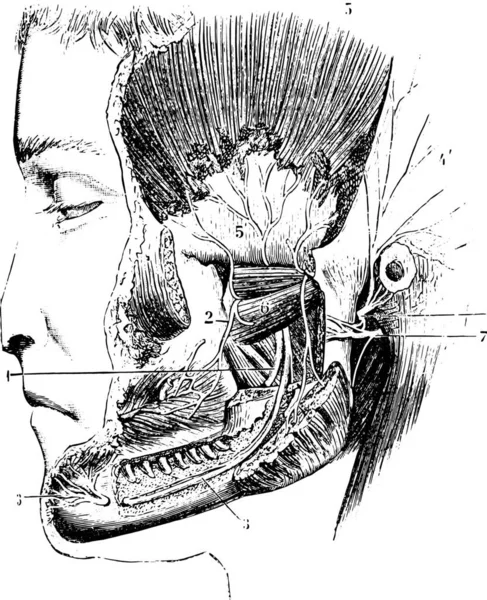 侧面翼状或外部翼状 复古雕刻插图 Labarthe博士的 普通医学词典 1885年 — 图库矢量图片