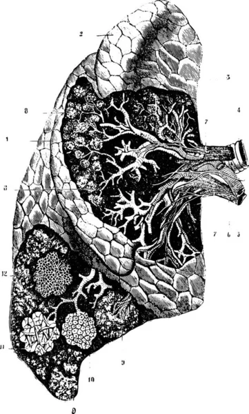 外部確認 肺の内部組織と構造 ヴィンテージ刻まれたイラスト ラブラドール博士の医学辞典 1885 — ストックベクタ
