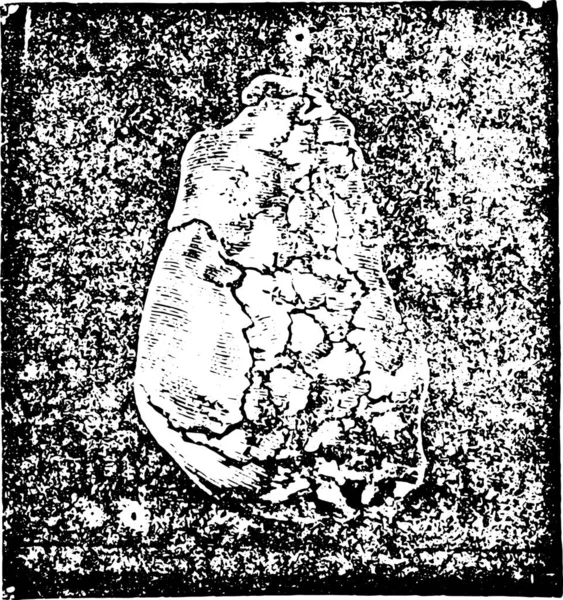 膀胱粘膜中の尿酸塩エンチャトンの計算と前駆体サイズによって抽出 プロファイルで ヴィンテージ刻まれたイラスト ラブラドール博士の医学辞典 1885 — ストックベクタ