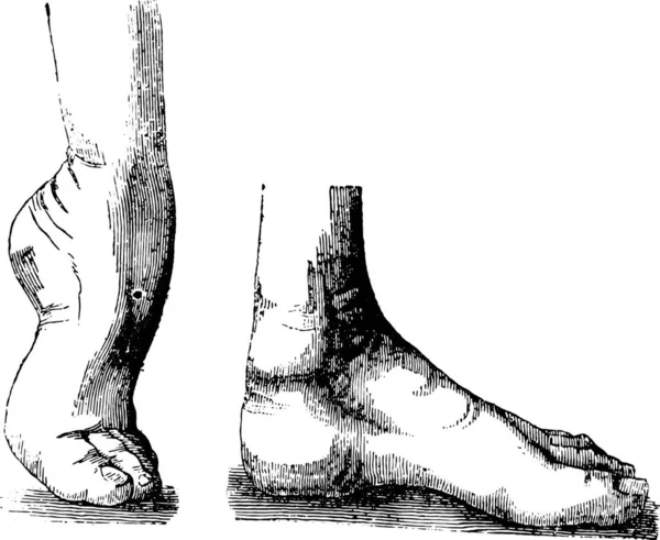 在手术前和手术后 双足或双足或先天性滑头马蹄 Ctev 古老的雕刻图解 Labarthe博士的 普通医学词典 1885年 — 图库矢量图片