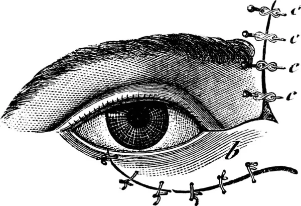 Fig 178 Blepharoplasty Method Blasius Vintage Engraved Illustration Usual Medicine — Stock Vector