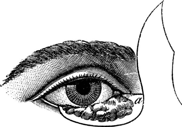 177 眼袋的布莱修斯法等复古刻的插图 通常医学词典 保罗拉巴尔特 1885 — 图库矢量图片