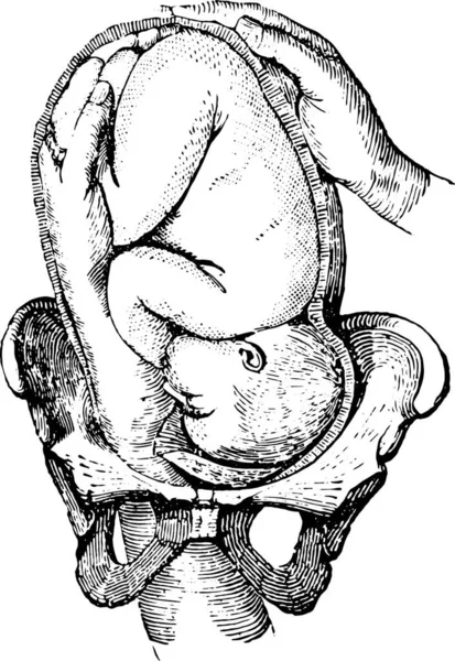 外部头像版本 如何使脚能按其先前的计划爱抚孩子 老式雕刻插图 Labarthe博士的 普通医学词典 1885年 — 图库矢量图片