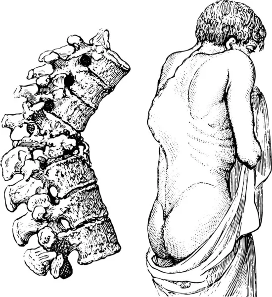 Corcunda Doença Vertebral Doença Pott Ilustração Gravada Vintage Dicionário Medicina — Vetor de Stock