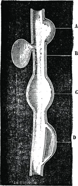 一种原始的动脉瘤 结节性动脉瘤 梭形动脉瘤 解剖动脉瘤 古老的雕刻插图 Magasin Pittoresque 1875年 — 图库矢量图片