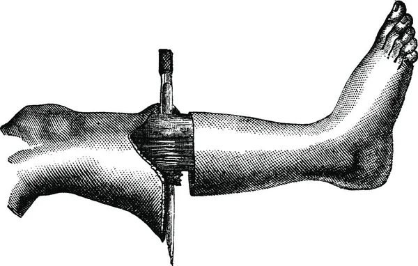 截肢的方法有两个瓣 圆形切口和形成的第一瓣 复古刻图 玛佳欣 Pittoresque 1875 — 图库矢量图片