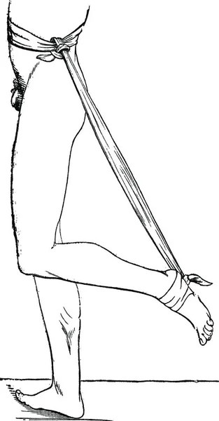 足部伸展和腿屈曲的装置 用于肌腱断裂 阿基里斯 古老的雕刻图解 Magasin Pittoresque 1875年 — 图库矢量图片