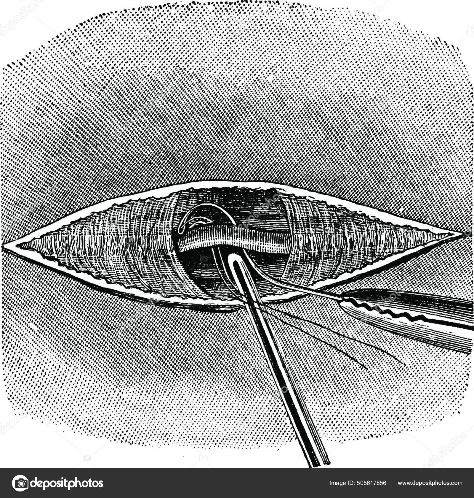 Placement Ligature Fil Avec Une Aiguille Deschamps Sonde Cannelée