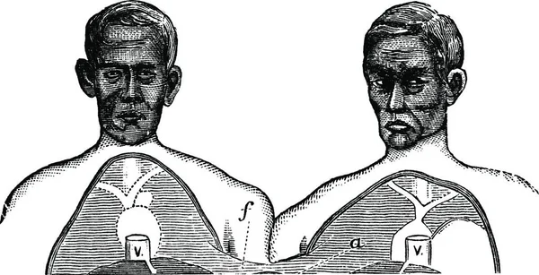 Siamesiska Tvillingar Vena Cava Övre Gräns För Den Gemensamma Axeln — Stock vektor