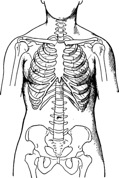 畸形的紧身胸衣 显示的情况下 妇女习惯性地穿紧身胸衣 老式雕刻插图 — 图库矢量图片