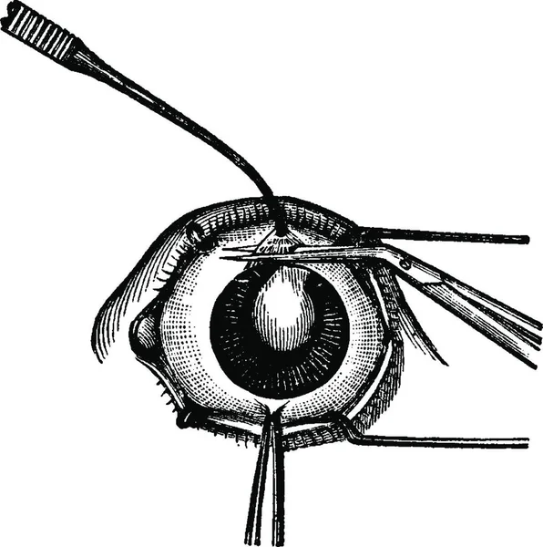 Iridektómia Csípőfogók Eltávolítása Felső Része Írisz Előtt Szürkehályog Műtét Vintage — Stock Vector