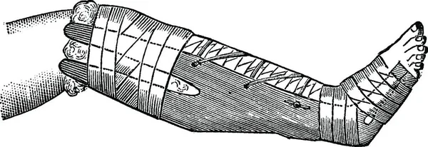用氧化锌或氨基酸锌制成的绷带包裹腿 用老式雕刻图解 Labarthe博士的 普通医学词典 1885年 — 图库矢量图片