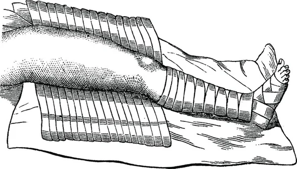 Частично Завернутая Бинт Нога Винтажная Гравированная Иллюстрация Словарь Обычной Медицины — стоковый вектор