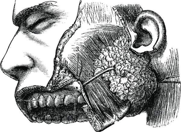 人类腮腺和类固醇肌肉 古老的雕刻插图 Labarthe博士的 普通医学词典 1885年 — 图库矢量图片