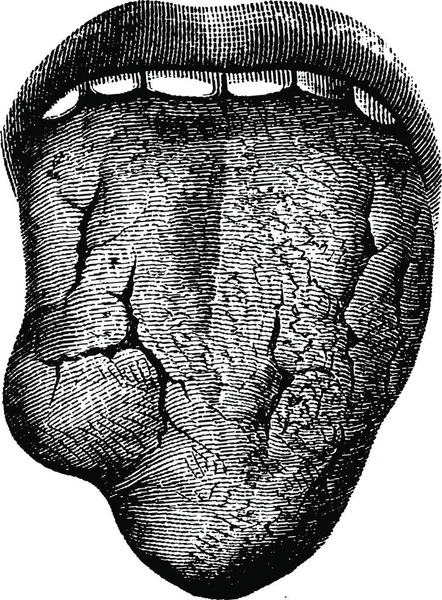人类舌头的肿瘤和梅毒溃疡病 古老的雕刻插图 Labarthe博士的 普通医学词典 1885年 — 图库矢量图片