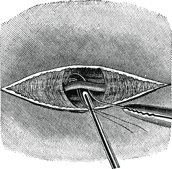 Placement Ligature Fil Avec Une Aiguille Deschamps Sonde Cannelée Déprimant — Image vectorielle