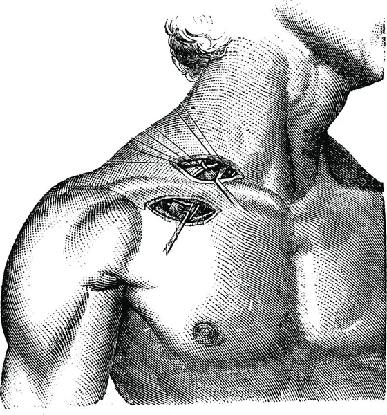 锁骨下动脉和腋窝的韧带 古老的雕刻图解 普通医学词典 Paul Labarthe 1885年 — 图库矢量图片