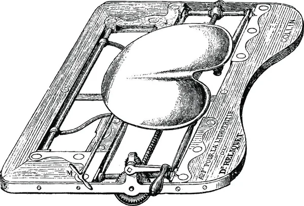 Apparatuur Voor Lithotripsy Zitting Lager Vintage Gegraveerde Illustratie Gebruikelijke Geneeskunde — Stockvector