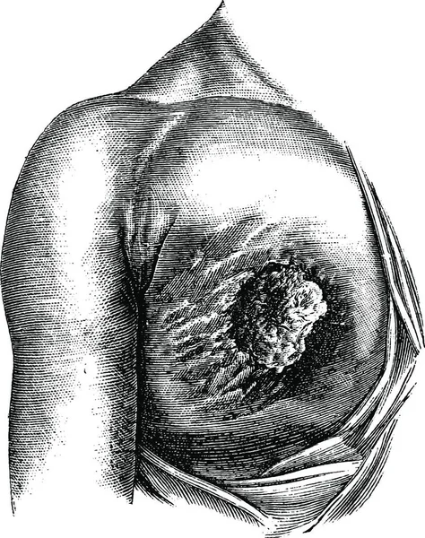 丸みを帯びた胸潰瘍は そのコアと周辺 ヴィンテージ刻まれたイラストを開発しています 医学雑誌 ポール ラバラ 1885 — ストックベクタ