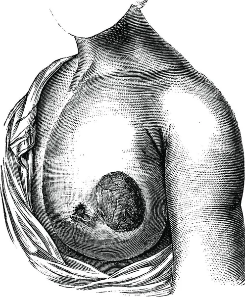 Kanker Payudara Meduler Ilustrasi Kuno Kamus Kedokteran Biasa Paul Labarthe - Stok Vektor