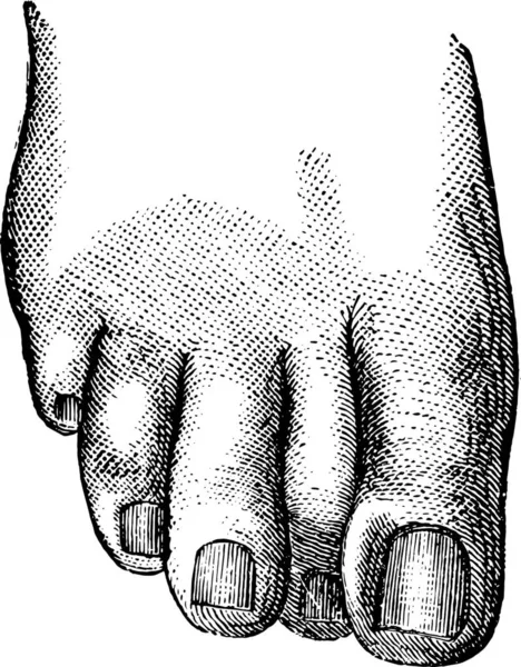 Kinci Ayak Parmağının Kusurlu Konumu Ikinci Ayak Parmağının Tırnağının Somutlaşmasına — Stok Vektör