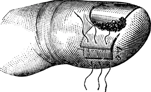 爪の操作は ヴィンテージ刻まれたイラストを体現しています 医学雑誌 ポール ラバラ 1885 — ストックベクタ