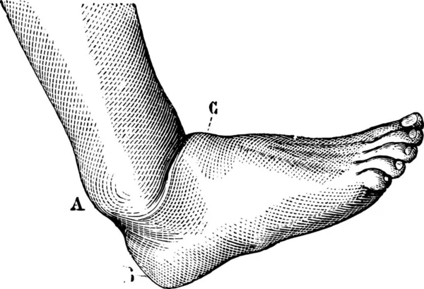 Vykloubení Nohy Vpřed Rytá Ilustrace Obvyklý Lékařský Slovník Paul Labarthe — Stockový vektor