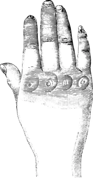 Sklerose Der Linken Hand Dorsal Gravierte Illustration Wörterbuch Der Gewöhnlichen — Stockvektor